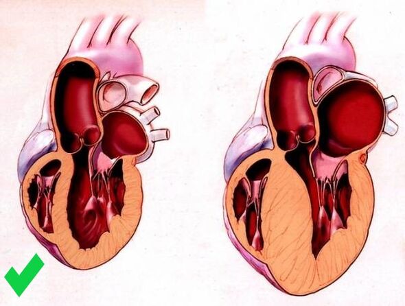 Cardione previene l'ipertrofia ventricolare del cuore